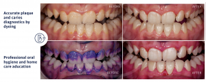 Plaque and caries diagnostics, professional oral hygiene